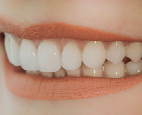 Veneers | Zahnarzt Gunnar Gansen Schönwalde