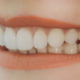 Veneers | Zahnarzt Gunnar Gansen Schönwalde