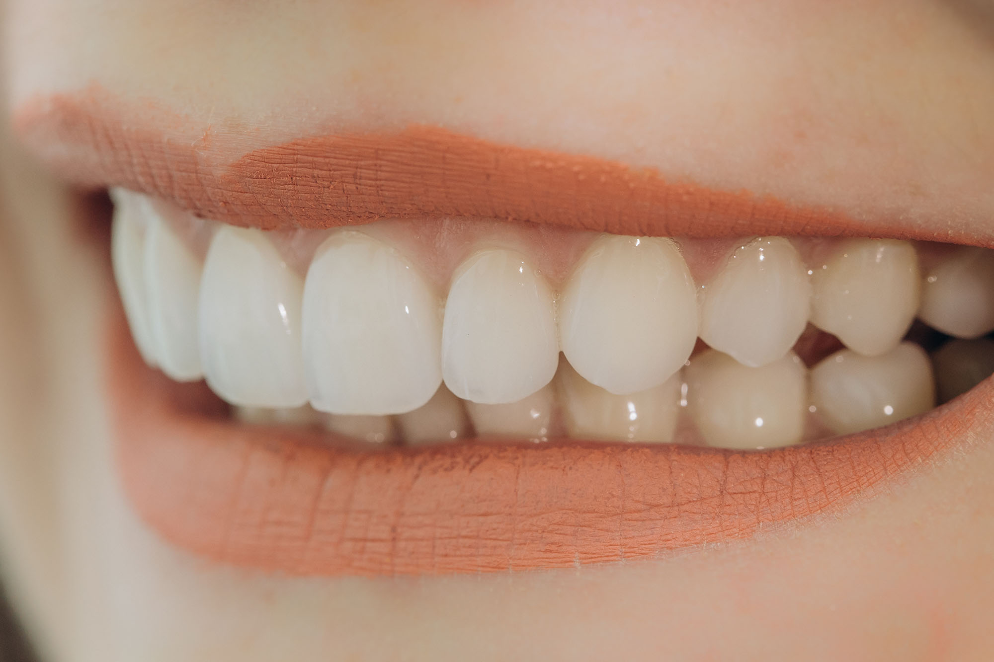 Veneers | Zahnarzt Gunnar Gansen Schönwalde